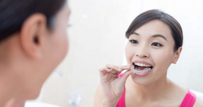 Woman puts in her invisible braces or aligners known as Impressions