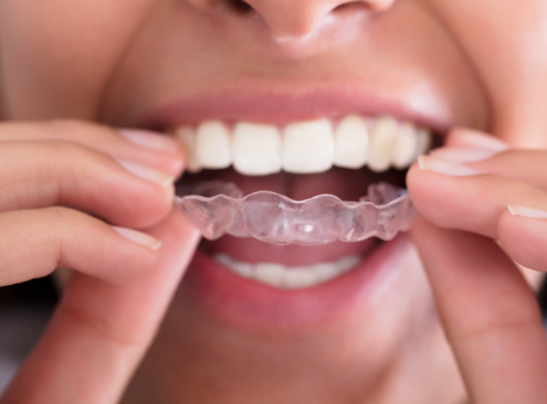 Woman putting in her Impressions invisible aligners in North Carolina