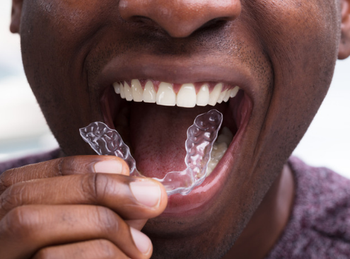 Man using invisible aligners to straighten his teeth at home