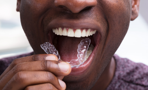 Man using invisible aligners to straighten his teeth at home