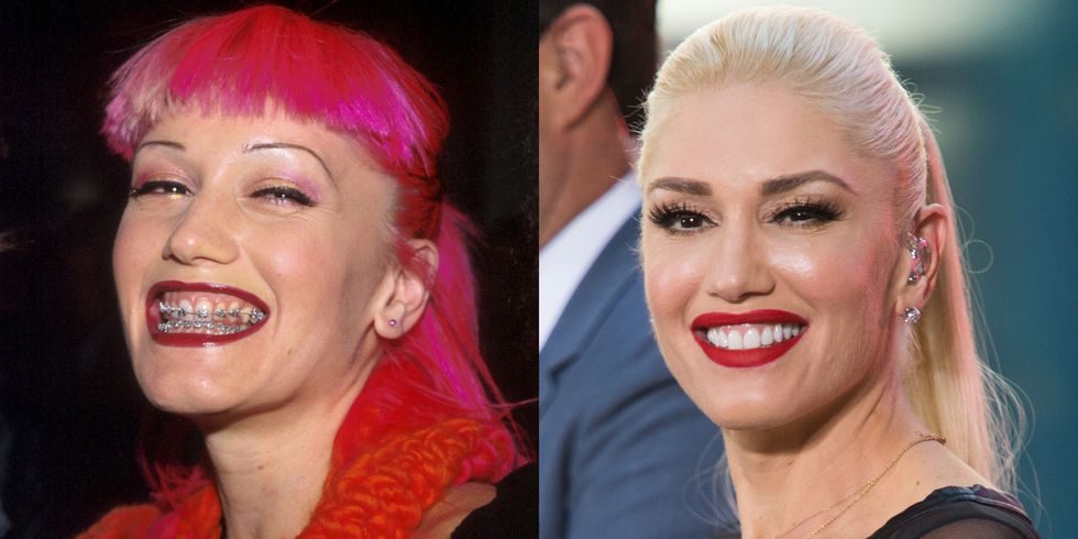 Before and after picture of Gwen Stefani smiling