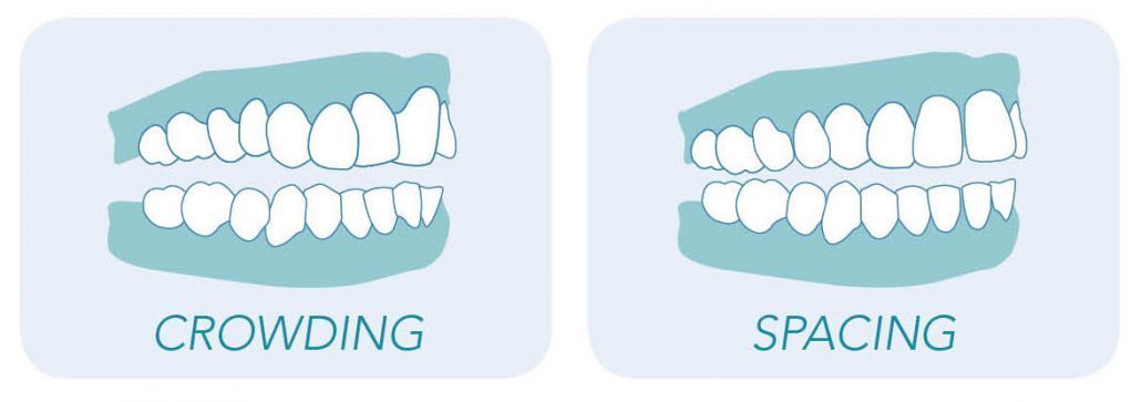 Graphics portraying teeth crowding and spacing
