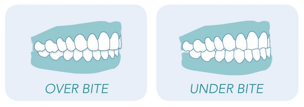 Graphic showing teeth overbites and under bites