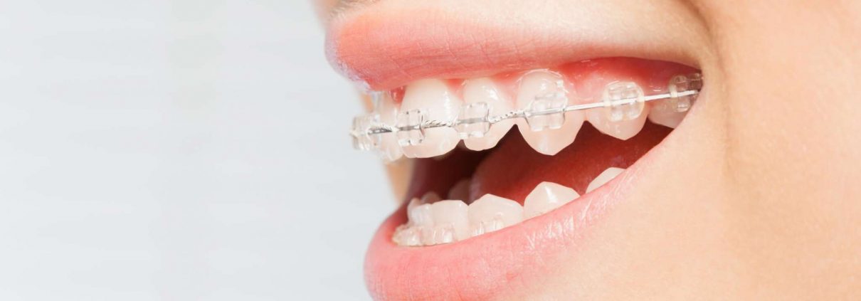 No.1 Lingual Braces - Voted Best Dental Practice in UK