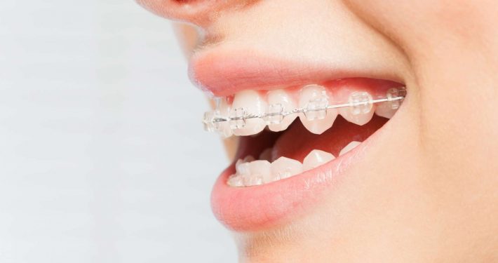 Person with braces looks for cheaper alternative to straighten teeth at home