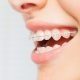 Person with braces looks for cheaper alternative to straighten teeth at home