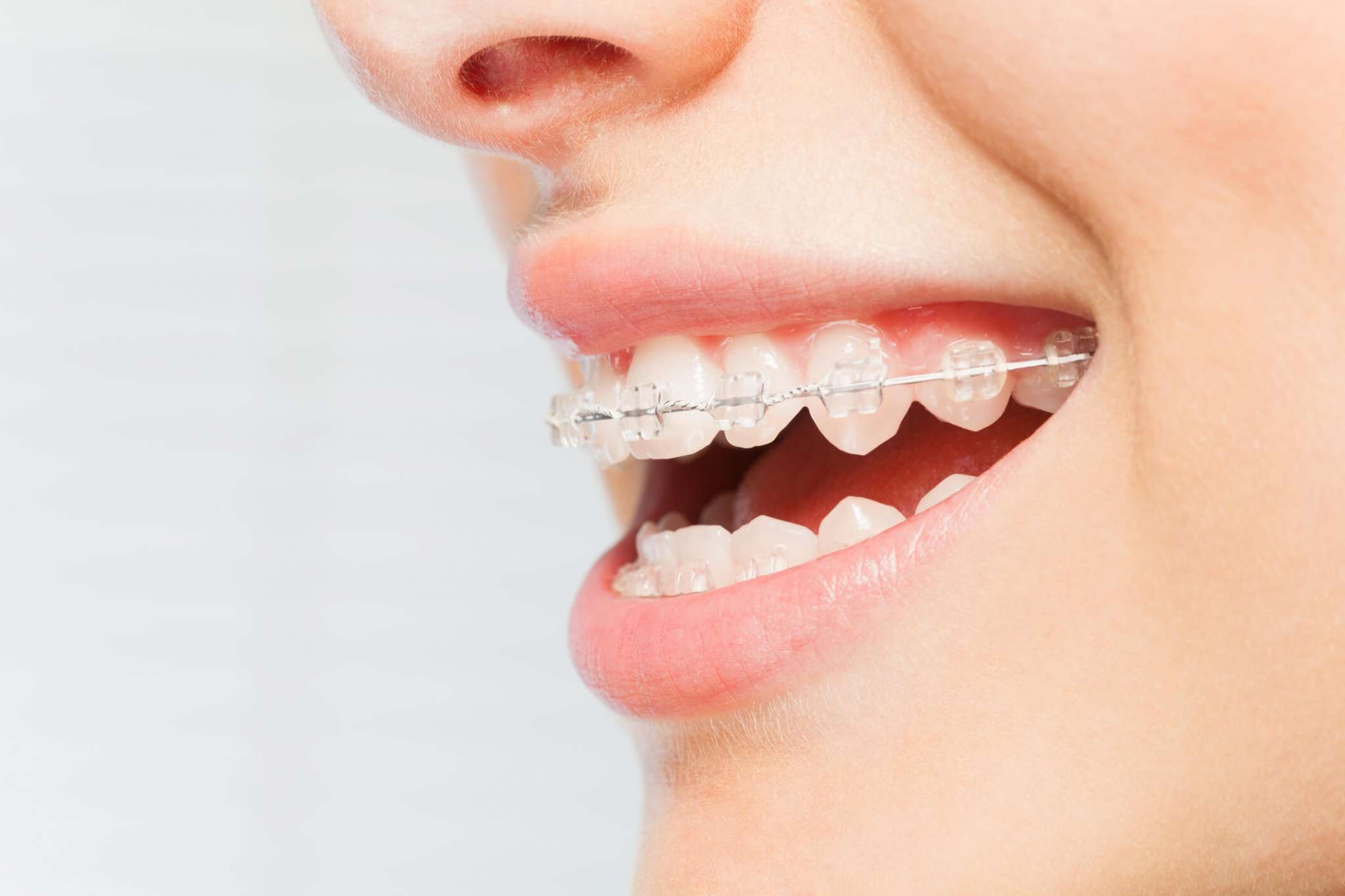 What are the Teeth Straightening Options for Adults in U.K?